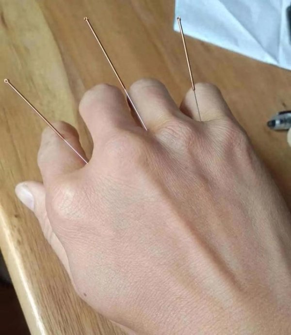 八戒策略 一穴调理手指麻木，竟是特效穴！