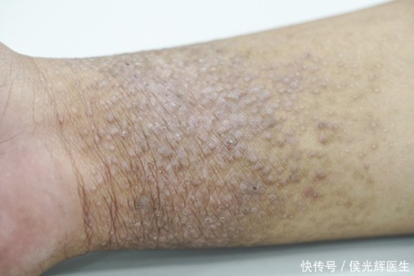 九牛网 医生直言：若你的胃镜报告，没有这3点提示，说明胃癌离你还很远